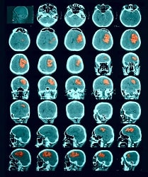 Brain CT